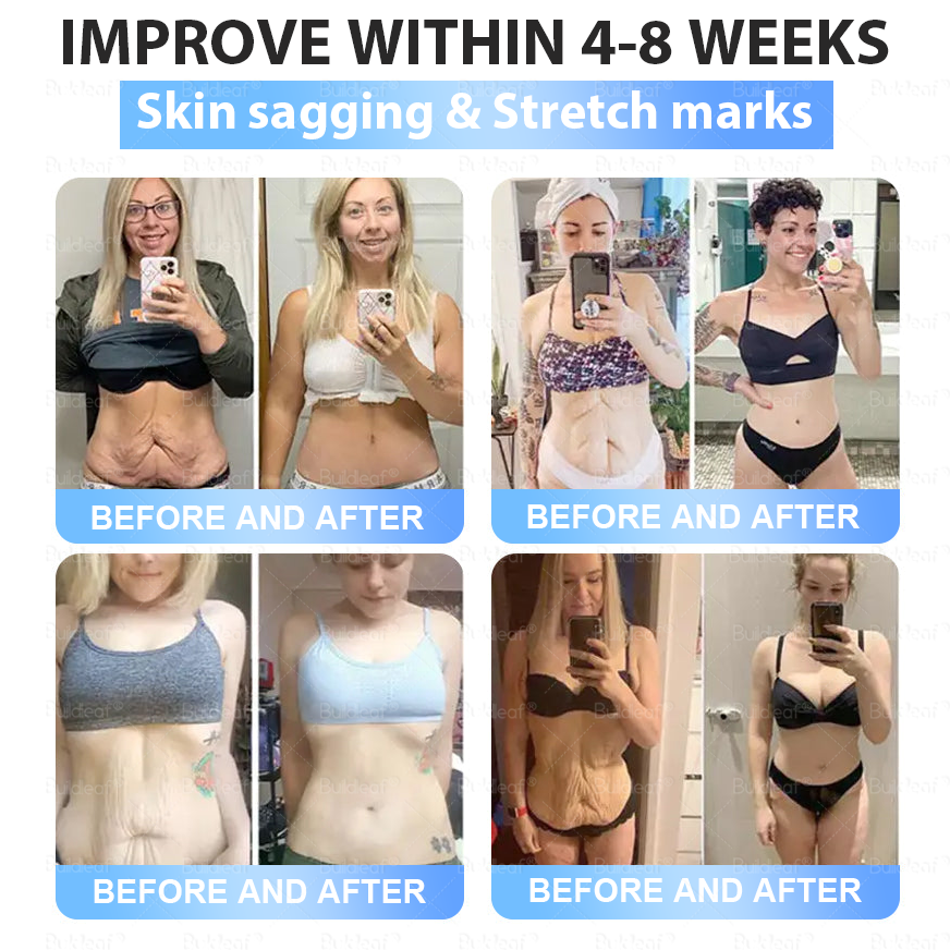 ✨⭐US Clinically Proven| Official Store | Buildleaf® Tirzepatide Slimming & Health Nano Microneedle Patch |Targets Obesity, Loose Skin, High Blood Pressure, Diabetes, Fatty Liver, Joint Pain, Brain Fog, Low Energy, Body Aches, and More