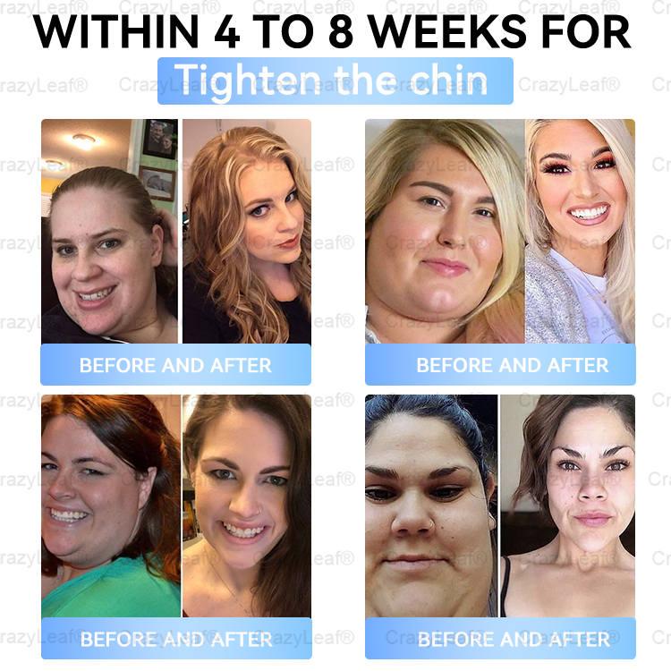 ✨⭐US Clinically Proven| Official Store | Buildleaf® Tirzepatide Slimming & Health Nano Microneedle Patch |Targets Obesity, Loose Skin, High Blood Pressure, Diabetes, Fatty Liver, Joint Pain, Brain Fog, Low Energy, Body Aches, and More