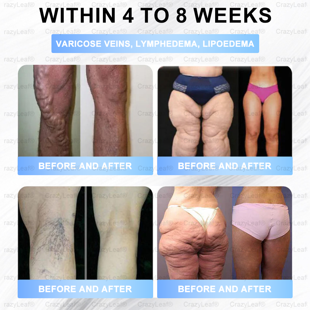 ✨⭐US Clinically Proven| Official Store | Buildleaf® Tirzepatide Slimming & Health Nano Microneedle Patch |Targets Obesity, Loose Skin, High Blood Pressure, Diabetes, Fatty Liver, Joint Pain, Brain Fog, Low Energy, Body Aches, and More