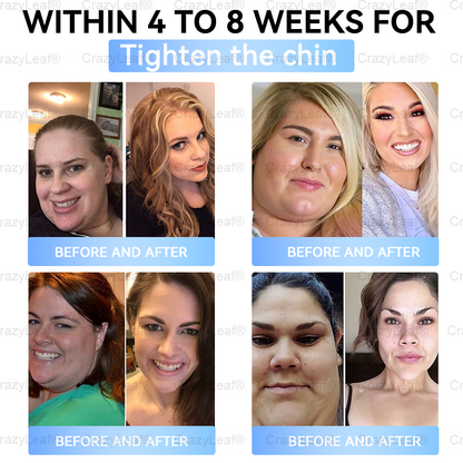 ✨⭐US Clinically Proven| Official Store | Buildleaf® Tirzepatide Slimming & Health Nano Microneedle Patch |Targets Obesity, Loose Skin, High Blood Pressure, Diabetes, Fatty Liver, Joint Pain, Brain Fog, Low Energy, Body Aches, and More